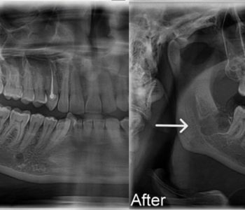 wisdom-tooth-removal-L
