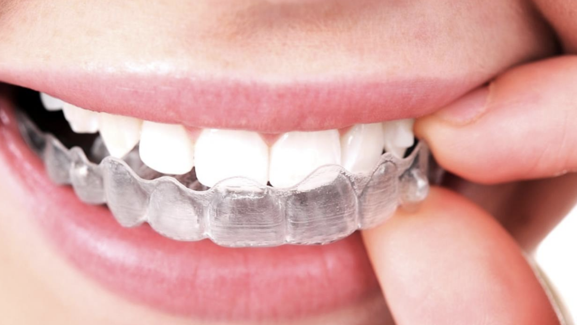 Invisalign – Clear Aligners 2020