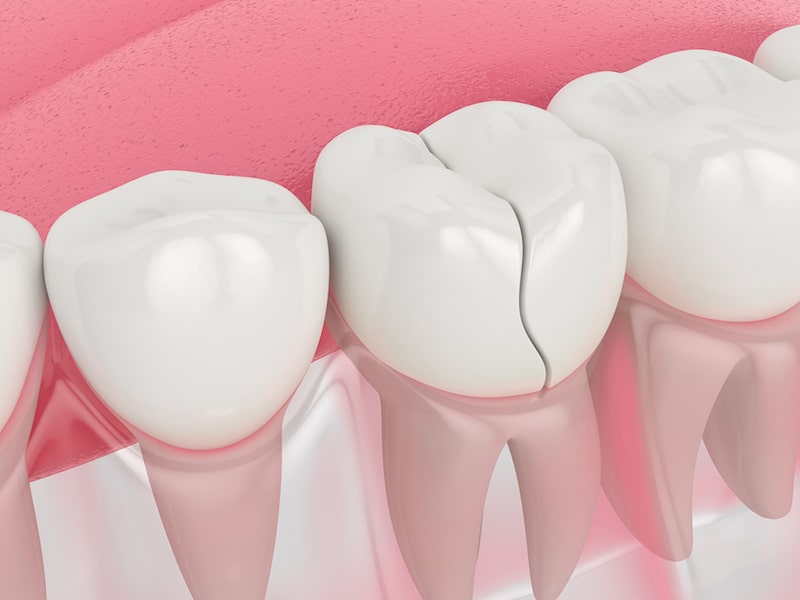 Cracked tooth may be a reason to your toothache