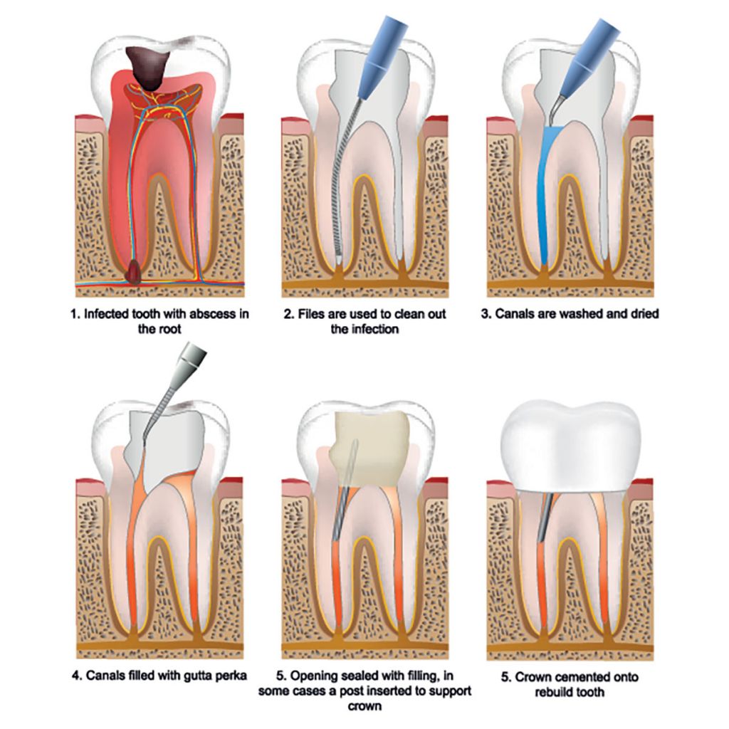 Root Canal Specialist near you | Root canal from $699