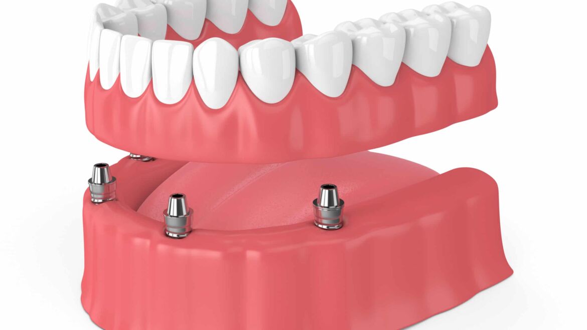 Snap-On Dentures or Implant Dentures
