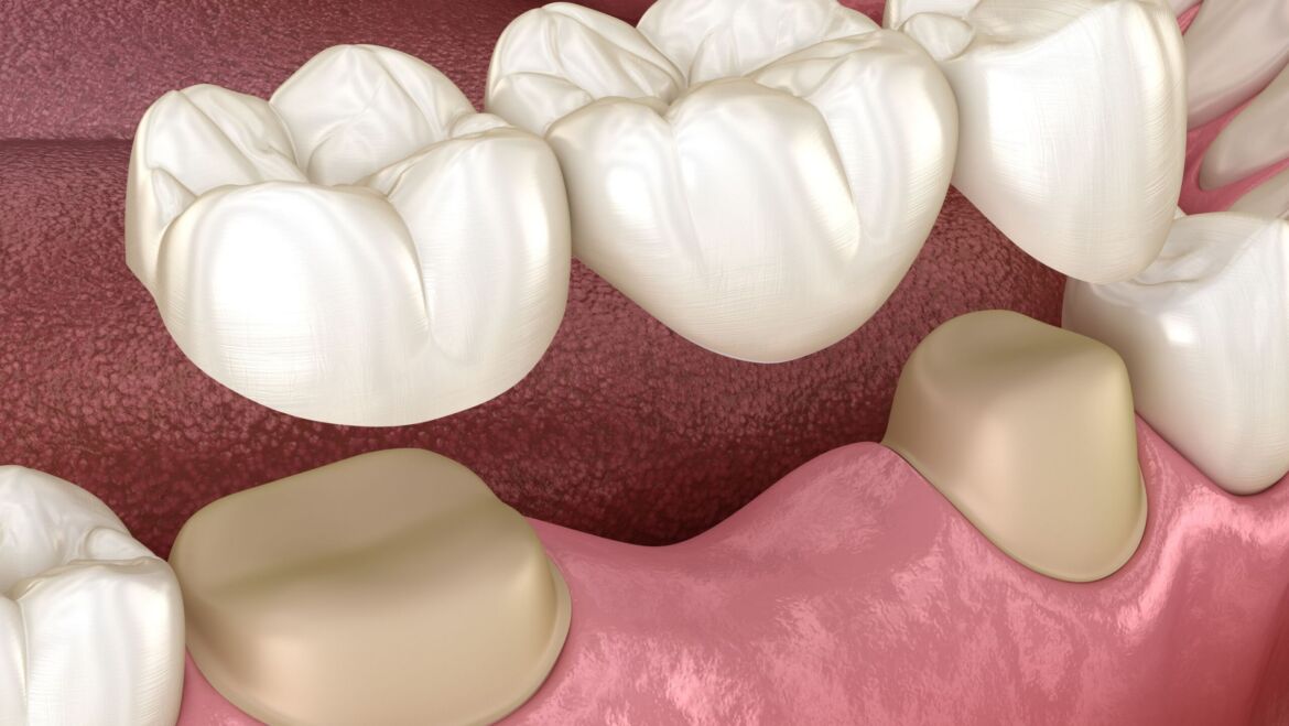 Dental Crown and Dental Bridge