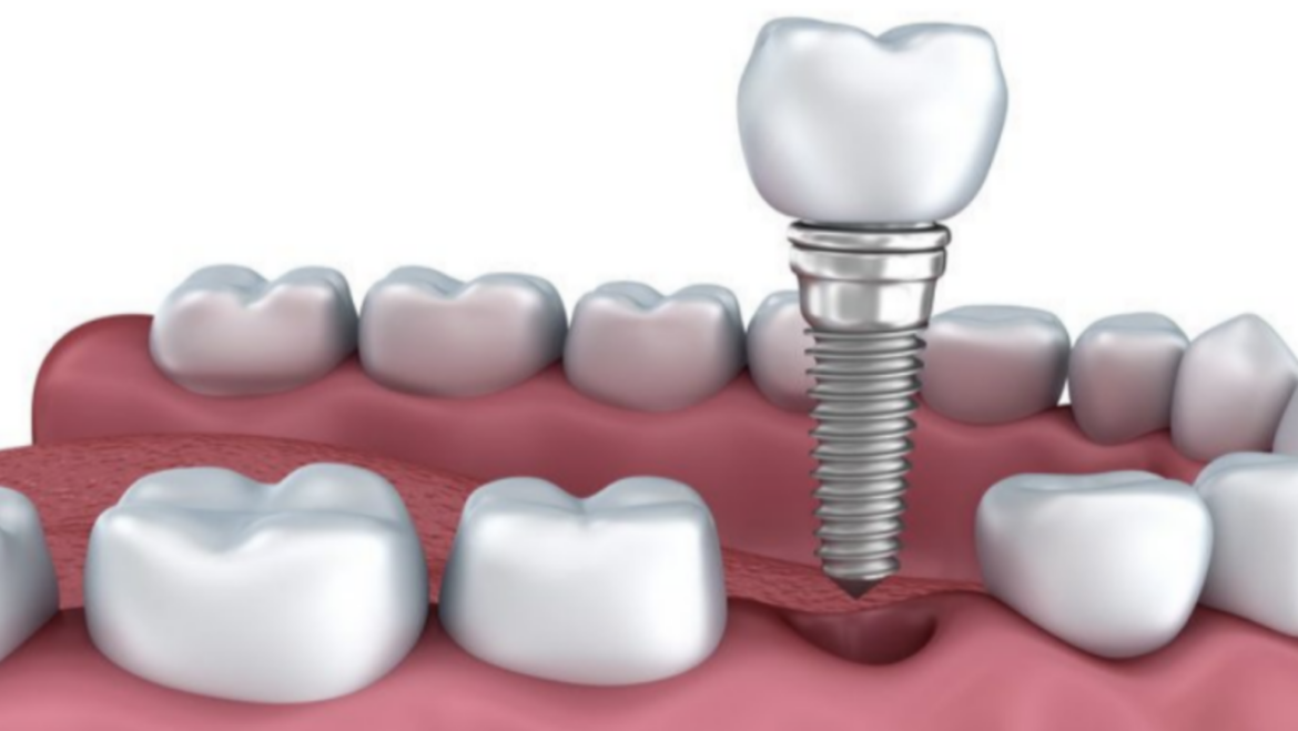 Dental Implant Solution in Coral Springs