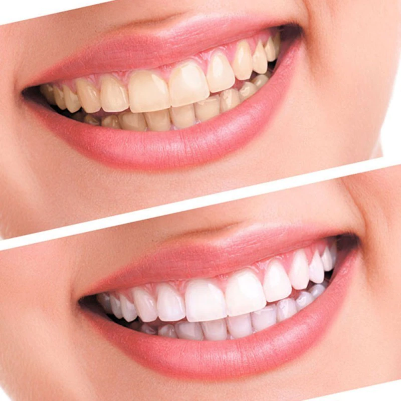 Whitening at Affordable Dentistry of Coral Springs 