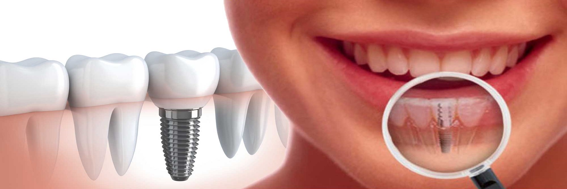 Prosthetics teeth restoration at Affordable Dentistry of Coral Springs