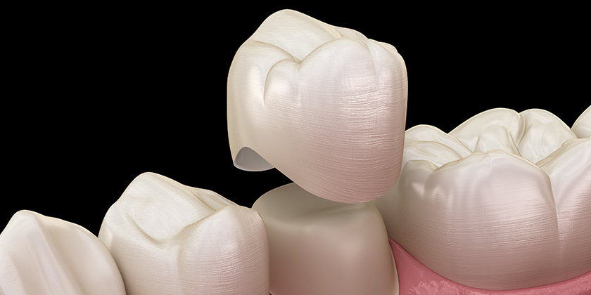What are Dental Crowns Made Of ?