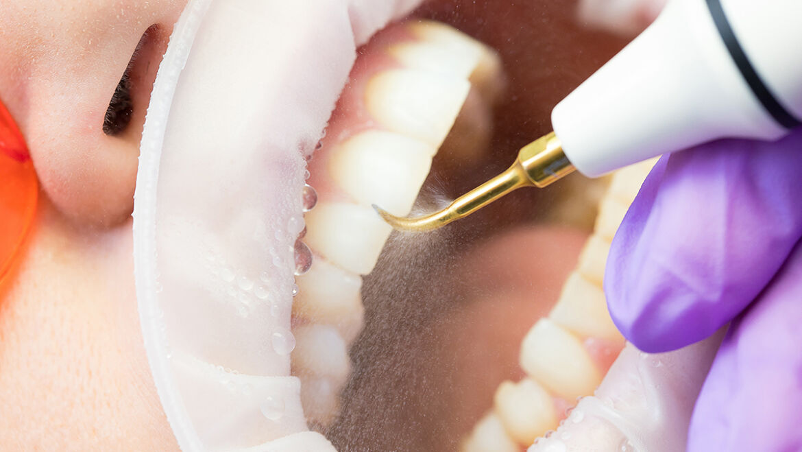 How Can Ultrasonic Cleaning Help Your Teeth?