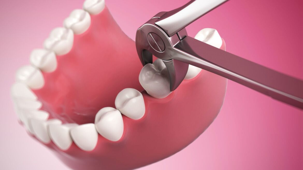 Tooth Extraction in Coral Springs. Dental Emergency.