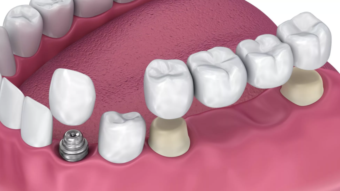 Dentist of Coral Springs will provide you couple options for your teeth restoration