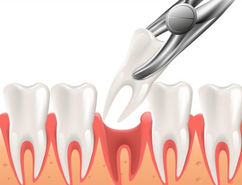 Simple and Surgical Teeth Extraction