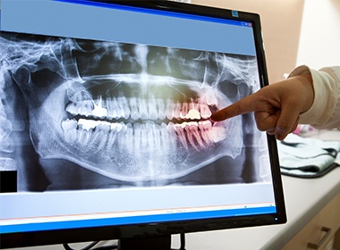 Panoramic X-ray at Affordable Dentistry of Coral Springs