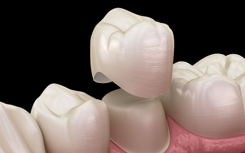 Tooth Crowns