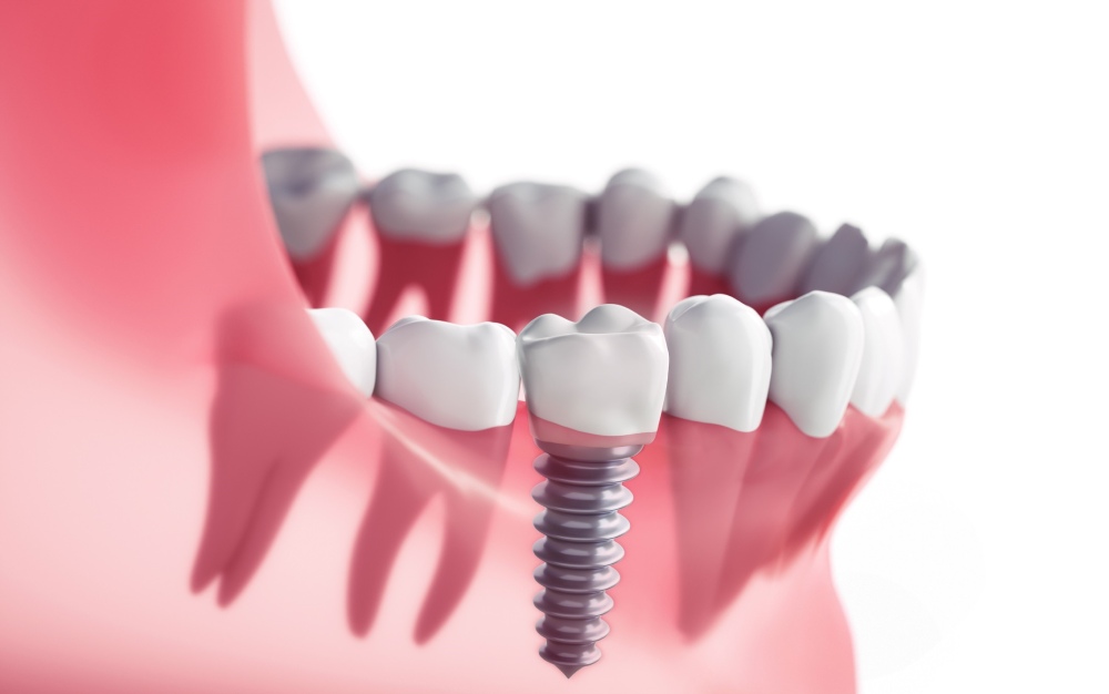 Permanent Dental Implants