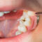 Exploring Cavities and Fillings: Understanding Prevention and Treatment