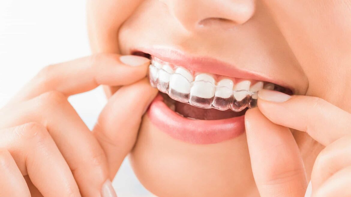 Exploring the Benefits of Aligners: Introducing Our Special Offer at $3,299