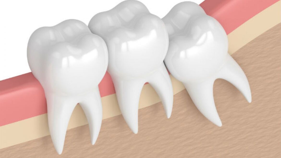 Wisdom Tooth Extractions: Benefits and Post-Operative Care