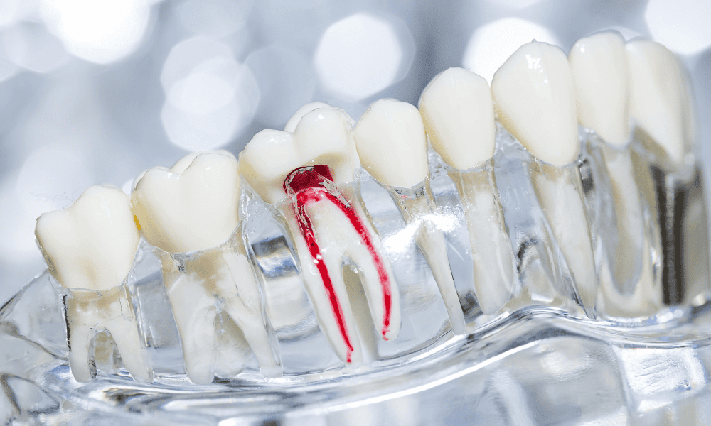 2_Root_Canal_Treatment