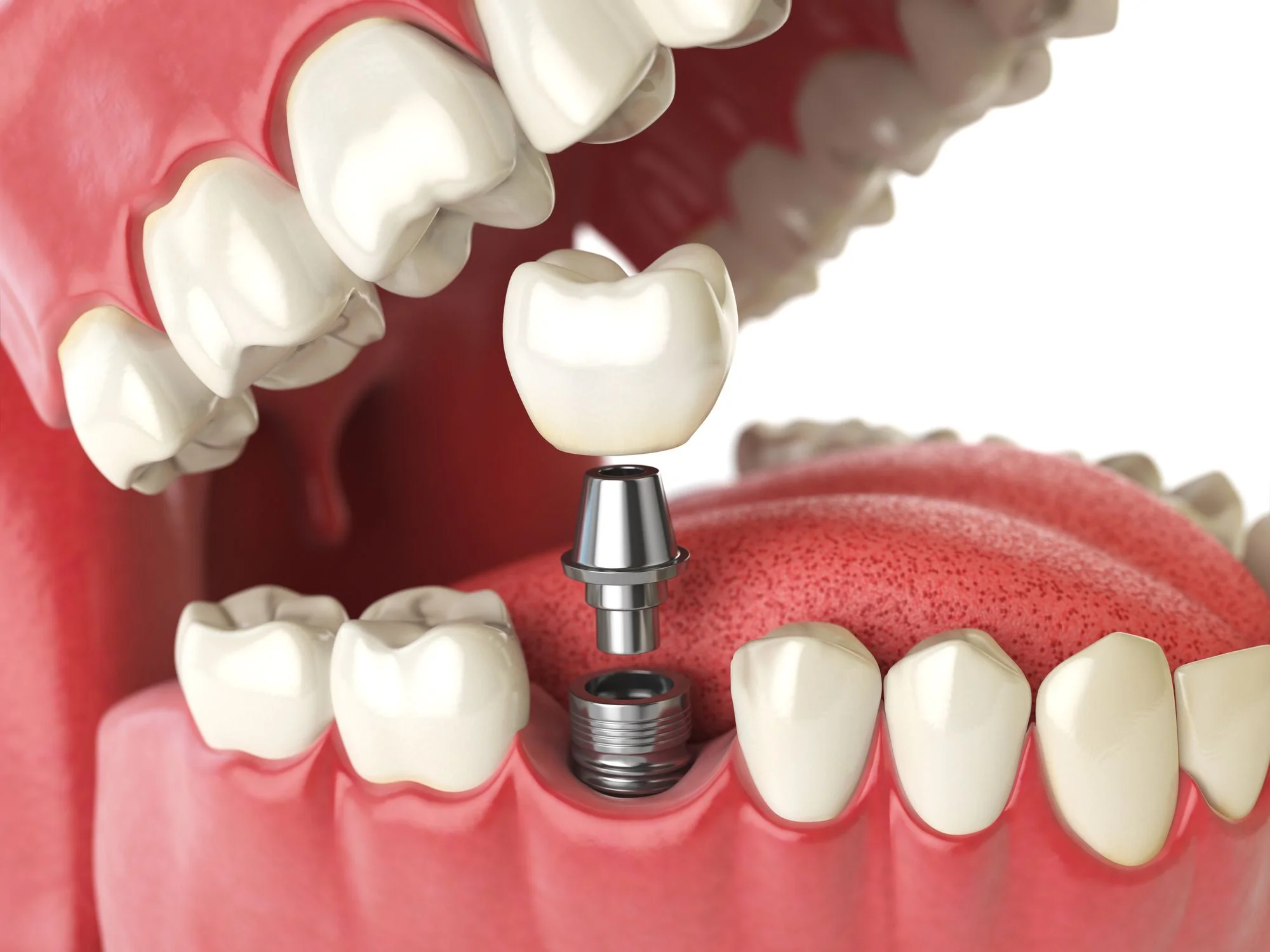 Dental-Implants3