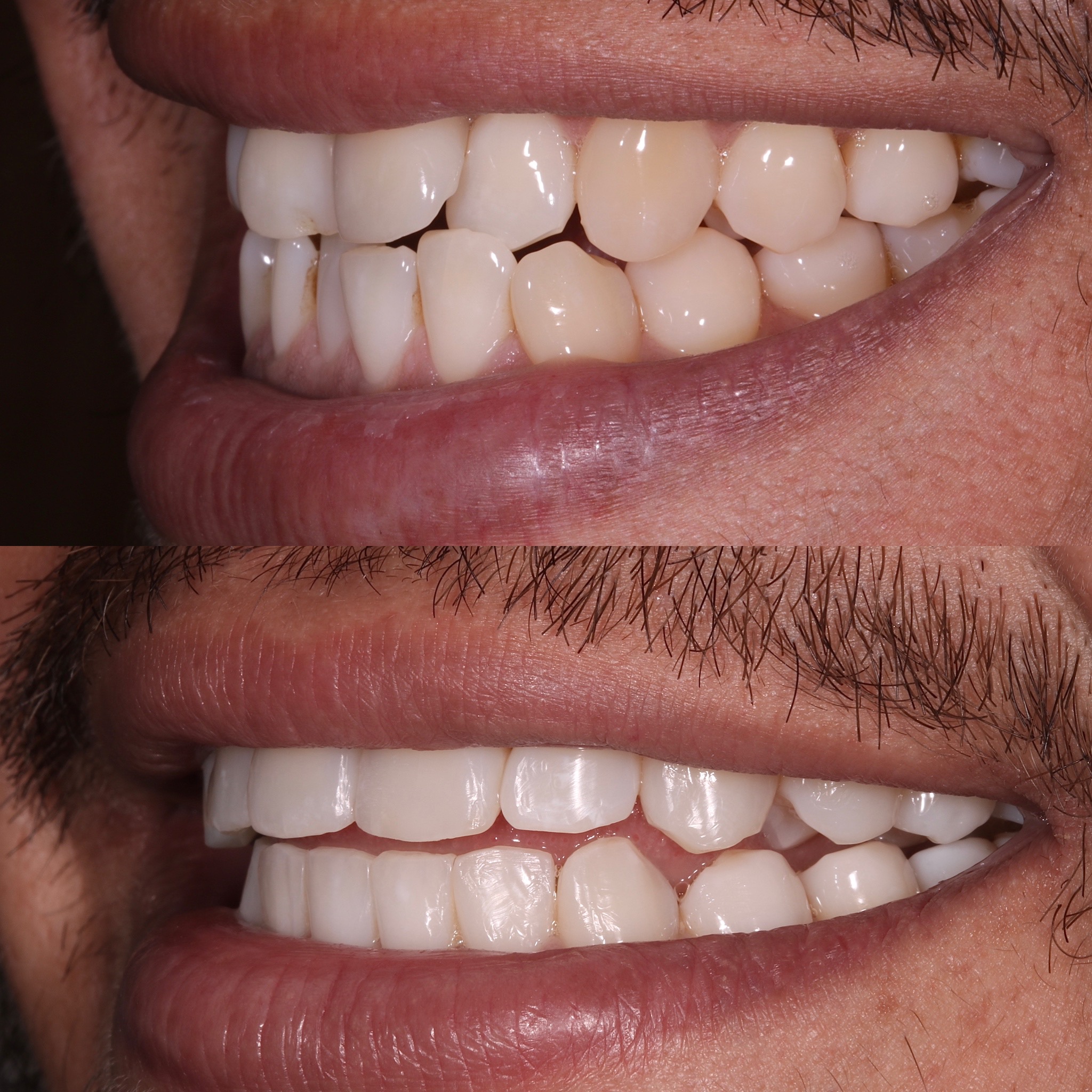 Invis whitening bonding