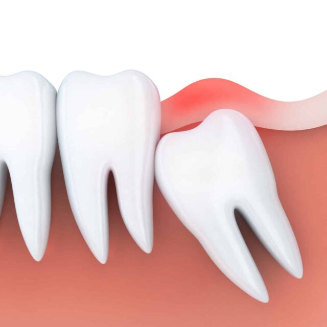 Toothache and inflammation in wisdom tooth. 3d illustration