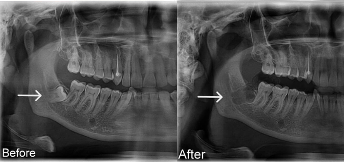 wisdom-tooth-removal-L
